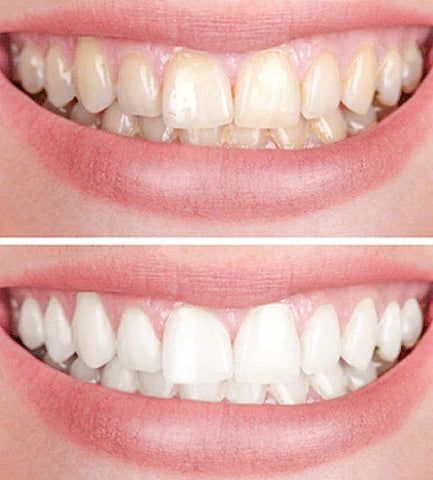 Clareador Dental VS White