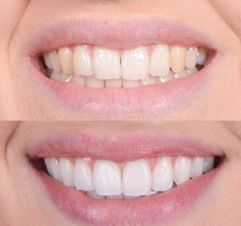 Clareador Dental VS White