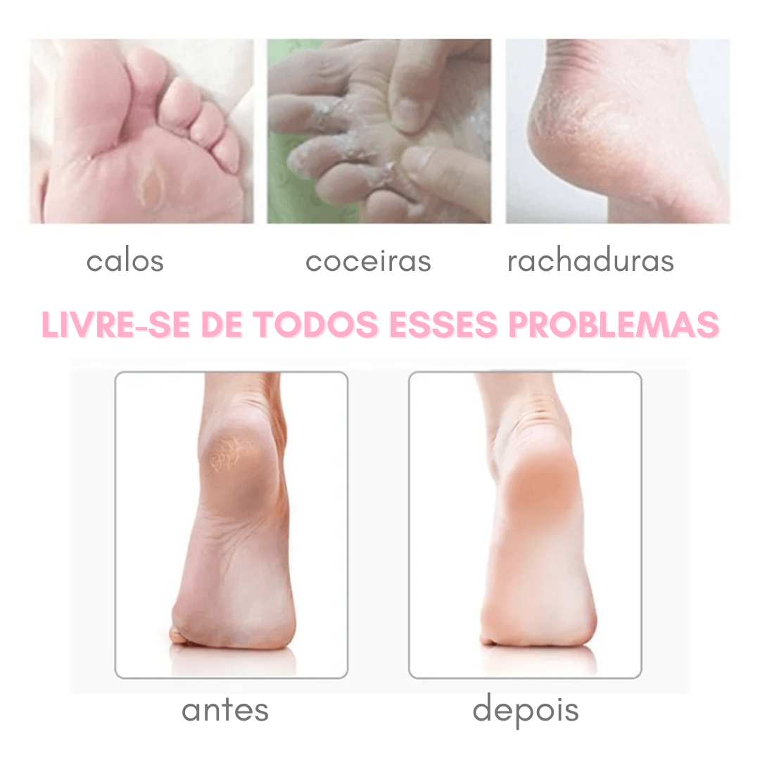 Removedor de Calos e Rachaduras dos Pés